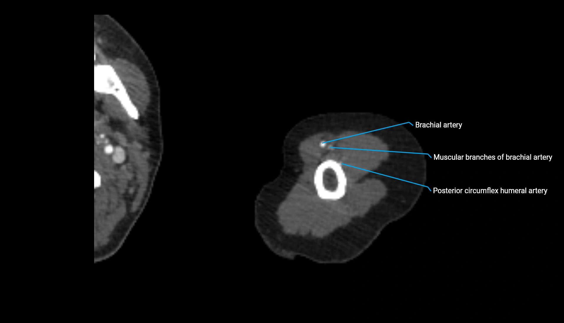 CTA upper limb axial cross sectional anatomy labelled image 288 (2).webp
